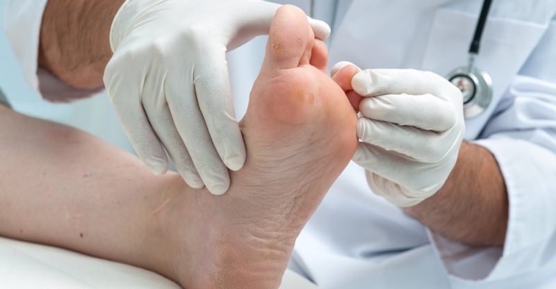 Athlete’s Foot