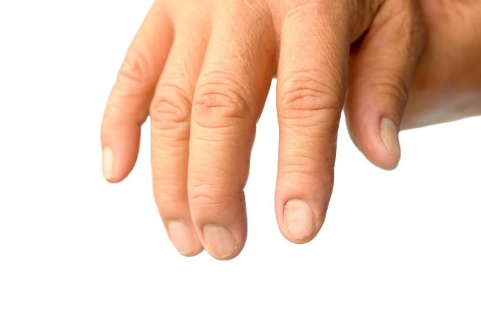 Brittle nails: MedlinePlus Medical Encyclopedia Image