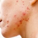 Cystic Acne Treatments