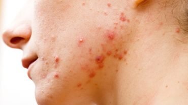 Cystic Acne Treatments