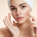 Essential Oils for Acne