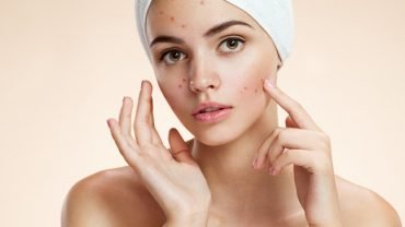 Essential Oils for Acne