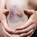 Essential Oils for Bruises