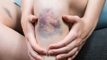 Essential Oils for Bruises
