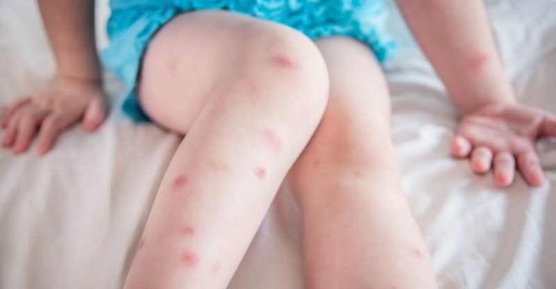 Essential Oils for Bug Bites