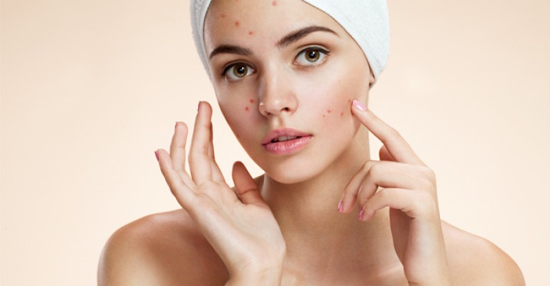 Home Remedies to Get Rid of Pimples Naturally - VOORKOM EN VERWIJDER PUISTJES SNEL OP EEN NATUURLIJKE NATUURLIJK 