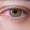How To Get Rid Of Red Eyes