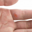 How To Remove Warts Using Apple Cider Vinegar