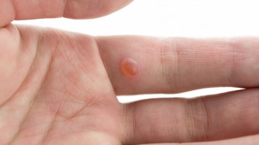 How To Remove Warts Using Apple Cider Vinegar