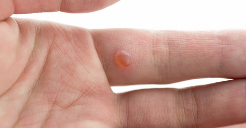 How To Remove Warts Using Apple Cider Vinegar