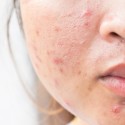how to get rid of acne scars