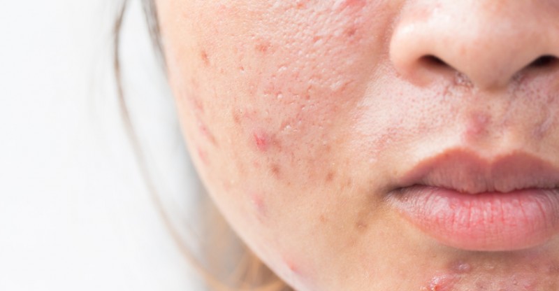 how to get rid of acne scars