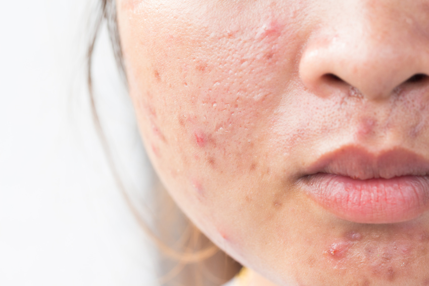 How To Get Rid Of Acne Scars Fast And Naturally 19 Strategies
