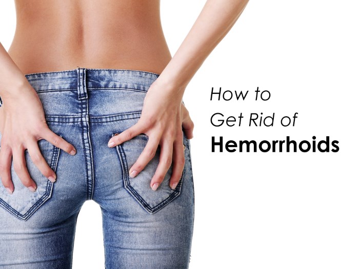 How to Get Rid of Hemorrhoids (22 Effective Remedies) WellBeing Secrets