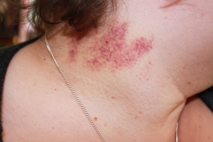 Hickies take out how to How to