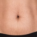 How-to-Get-Rid-of-Stretch-Marks-Fast