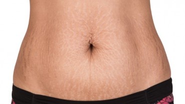 How-to-Get-Rid-of-Stretch-Marks-Fast