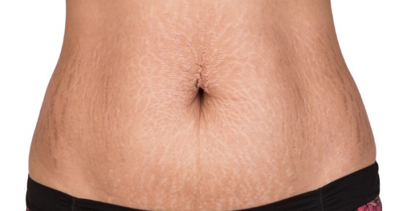 How-to-Get-Rid-of-Stretch-Marks-Fast