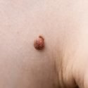 How to Remove Skin Tags