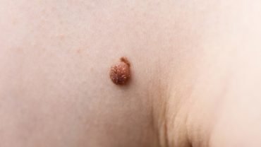 How to Remove Skin Tags