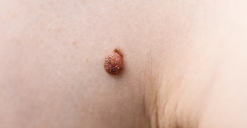 How to Remove Skin Tags