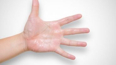 Remedies-for-Sweaty-Hands-and-Feet