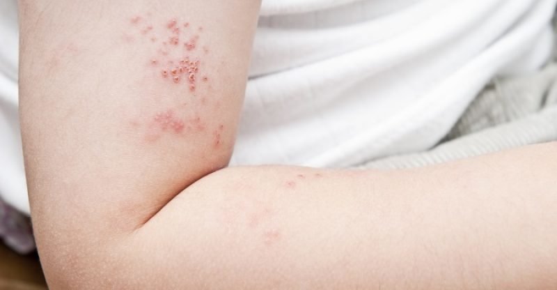 Shingles Natural Treatments