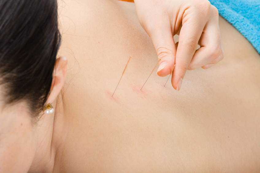 acupuncture session for detoxing