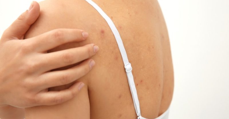back-acne-scars
