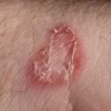 home remedies for ringworm