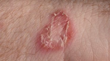 home remedies for ringworm