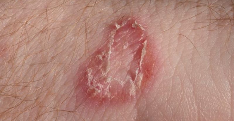 home remedies for ringworm