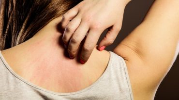 how-to-get-rid-of-a-rash
