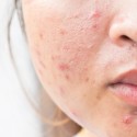 how to get rid of acne overnight