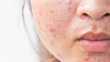 how to get rid of acne overnight