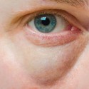 How to Get Rid of Puffy Eyes