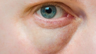 How to Get Rid of Puffy Eyes