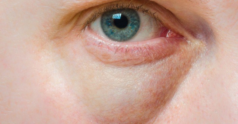 How to Get Rid of Puffy Eyes