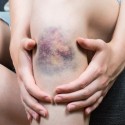how-to-get-rid-of-bruises