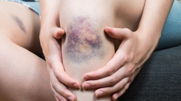 how-to-get-rid-of-bruises