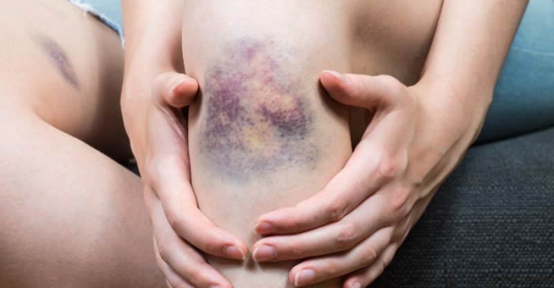 how to get rid of bruises 800x416 - 30 MANIEREN OM SNEL VAN BLAUWE PLEKKEN EN KNEUZINGEN AF ​​TE KOMEN
