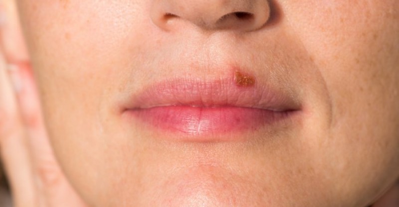 How To Get Rid Of Cold Sores Naturally 29 Remedies Well Being