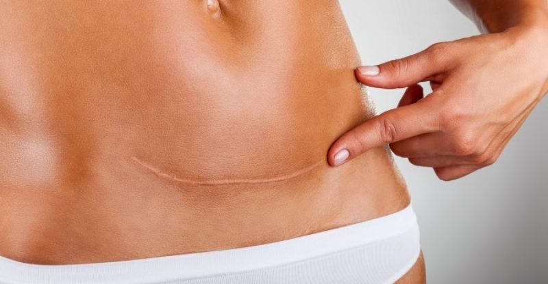 how-to-get-rid-of-scars