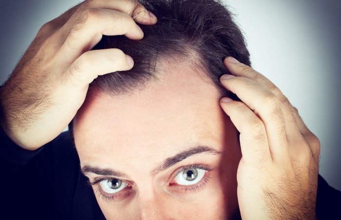 Stop ways balding to Treating female