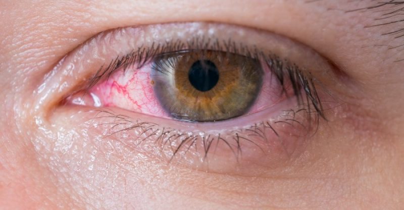 Pink Eye Symptoms Treatments And Remedies Well Being Secrets