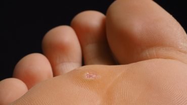 plantar-wart-removal-treatments