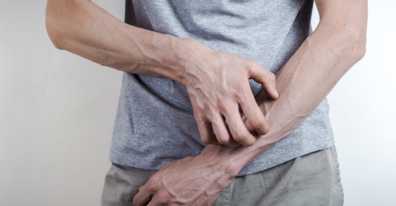 scabies-treatments-symptoms-and-remedies